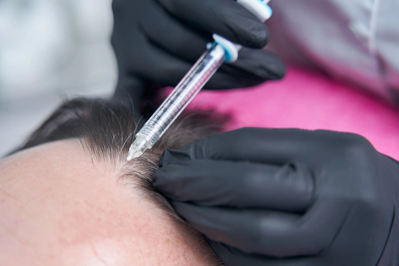 Microneedling with PRP