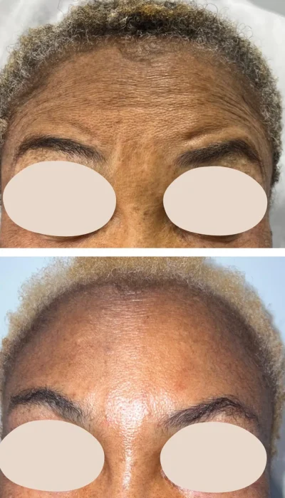 botox-forehead 1