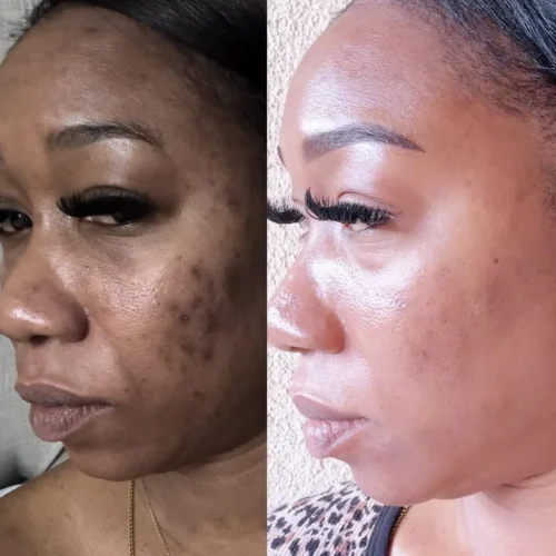 microneedling 1