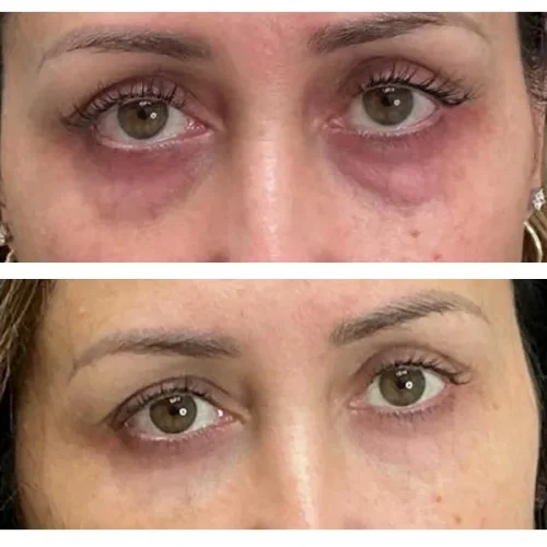 Before & After PRP and traditional filler