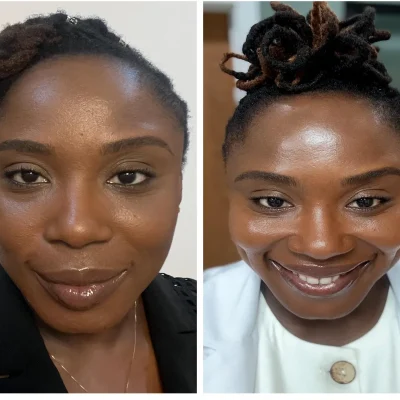 Befor & After fore PRP Gel chemical peel page